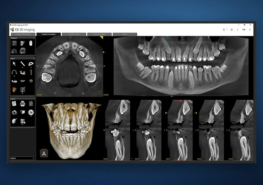 Reconstrução 3D a partir de CBCT
