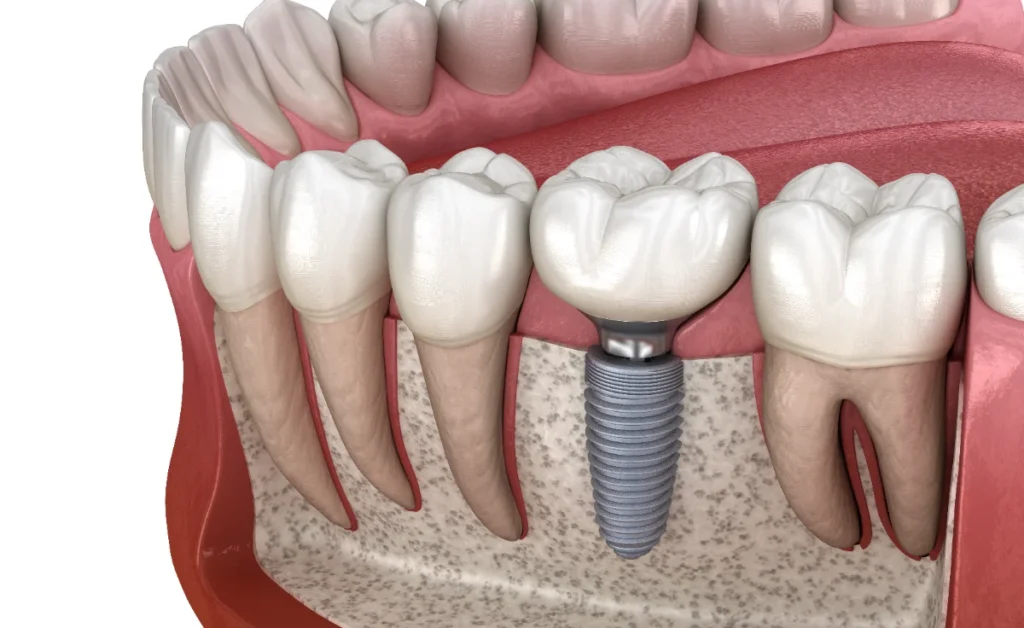 Implante dentário unitário — esquema 3D