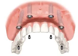Reabilitação total fixa sobre implantes — esquema 3D