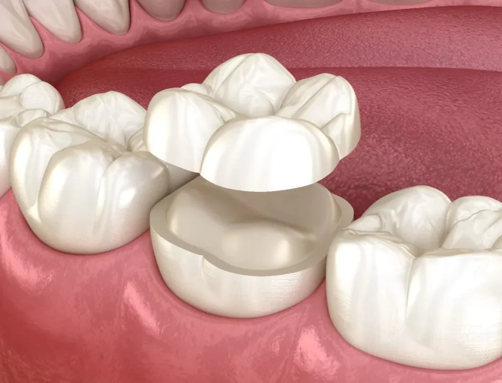 Resultado de dentes no próprio dia