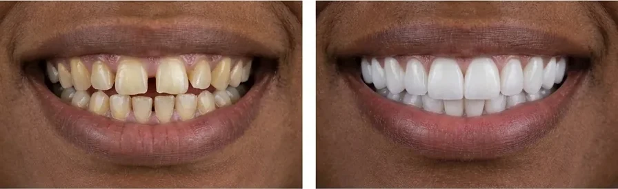 Caso de facetas dentárias — antes e depois