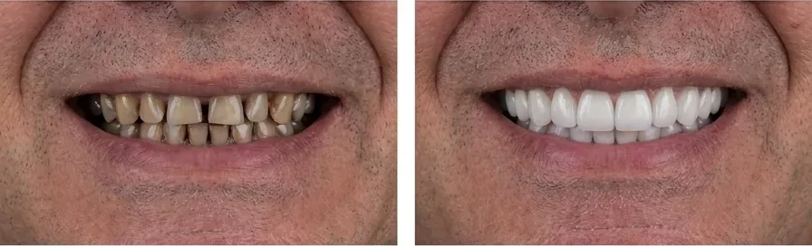 Caso de reabilitação do sorriso — antes e depois
